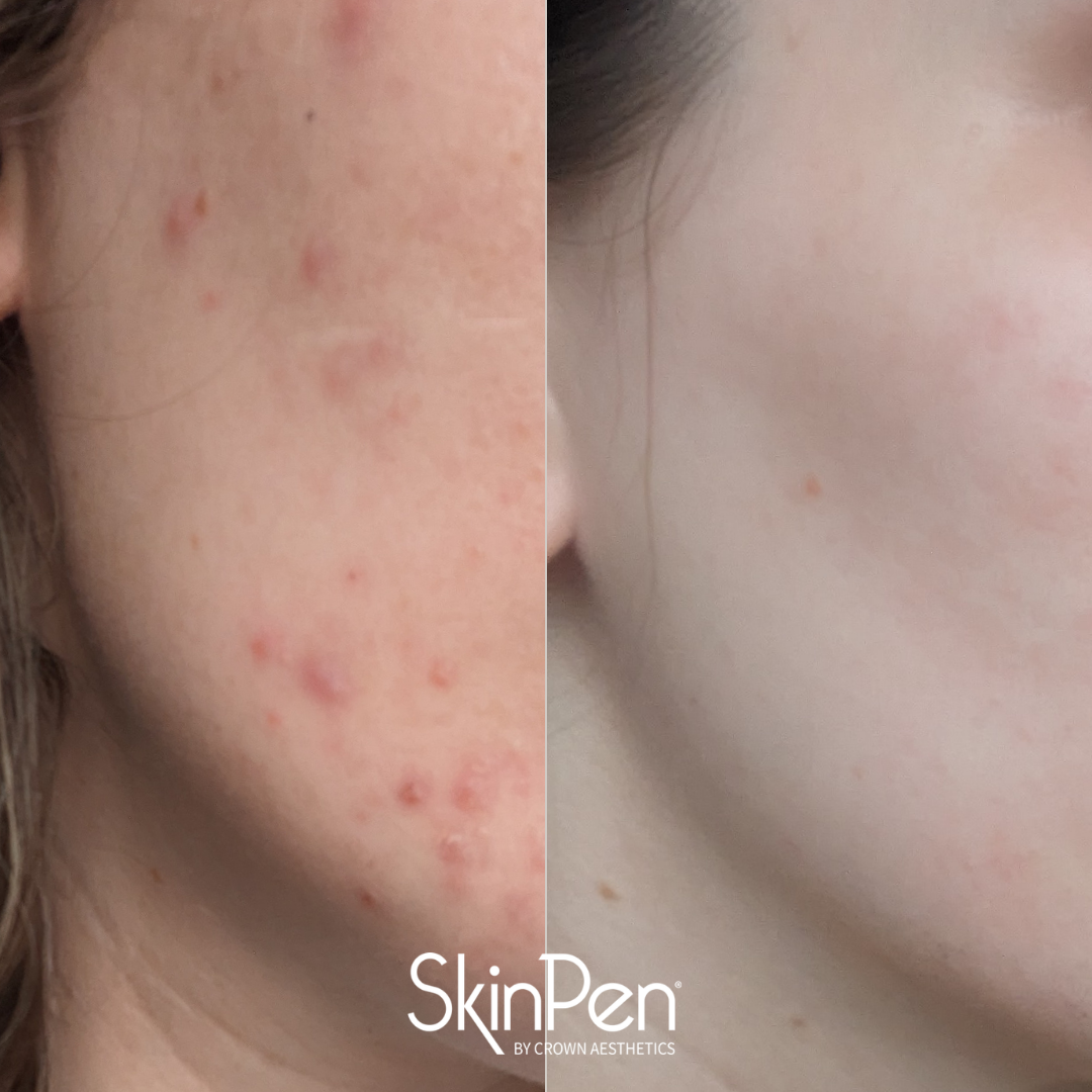 SkinPen microneedling before and after results on facial skin