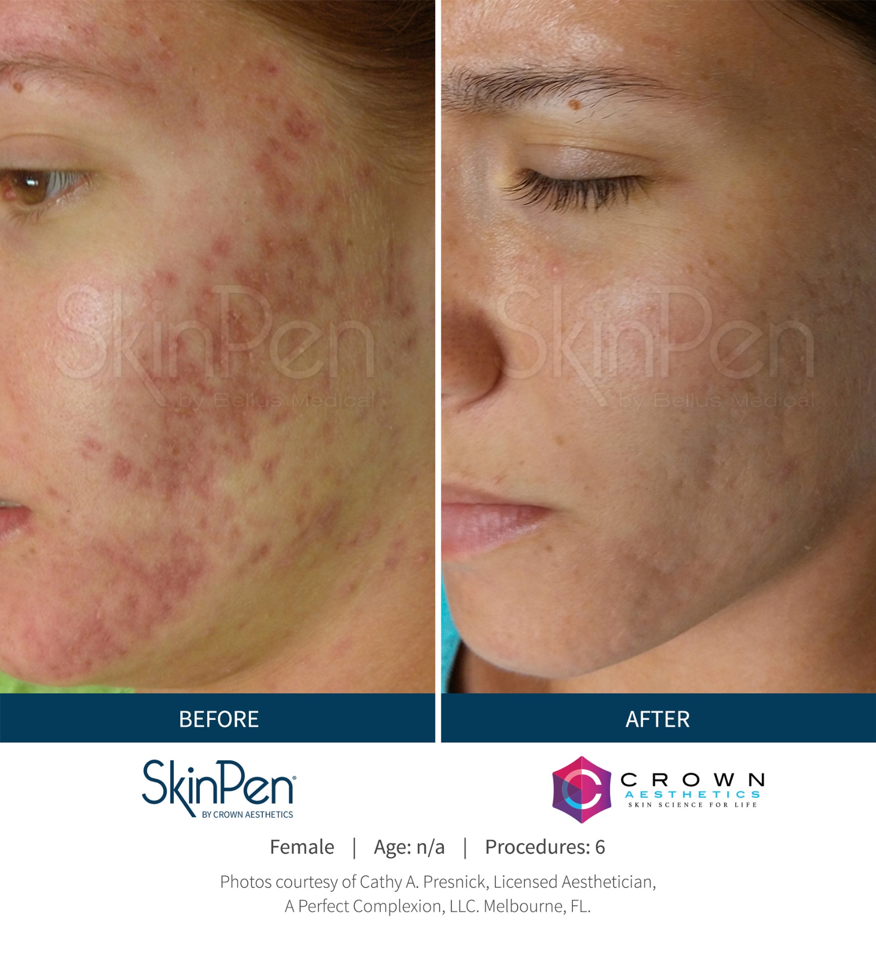 SkinPen before and after — acne scarring and texture after 6 sessions