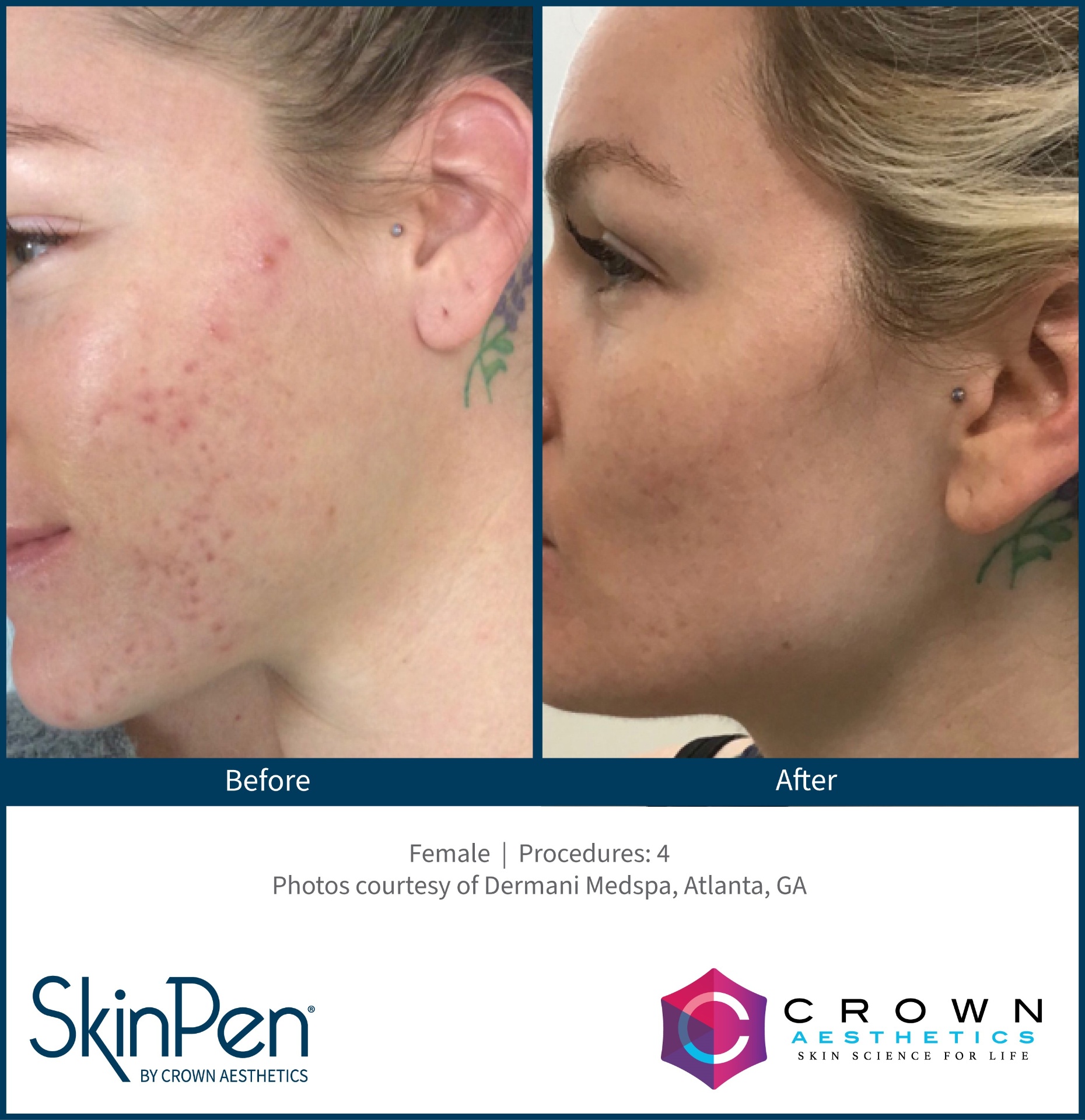 SkinPen before and after — acne scarring after 4 sessions
